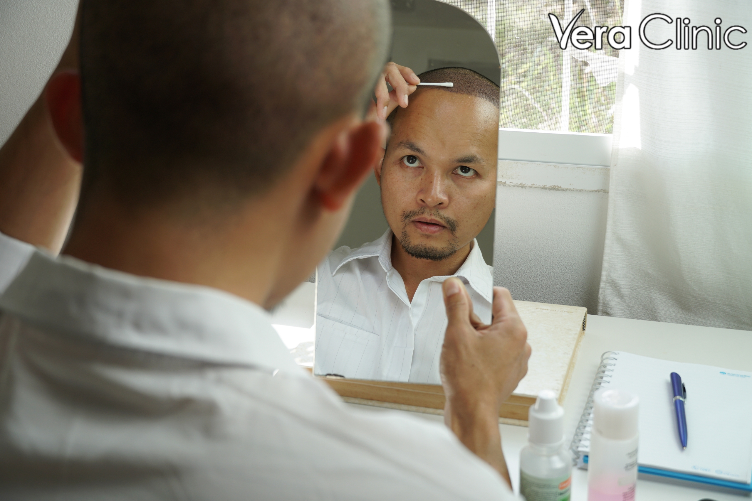 hair transplant turkey